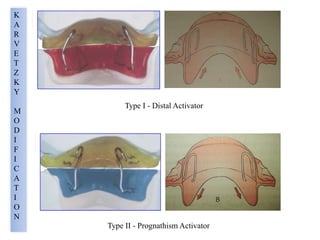 Type I - Distal Activator
Type II - Prognathism Activator
K
A
R
V
E
T
Z
K
Y
M
O
D
I
F
I
C
A
T
I
O
N
 