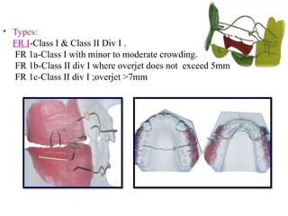 • Types:
FR I-Class I & Class II Div I .
FR 1a-Class I with minor to moderate crowding.
FR 1b-Class II div I where overjet does not exceed 5mm
FR 1c-Class II div I ;overjet >7mm
 