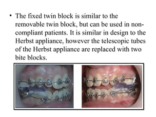 • The fixed twin block is similar to the
removable twin block, but can be used in non-
compliant patients. It is similar in design to the
Herbst appliance, however the telescopic tubes
of the Herbst appliance are replaced with two
bite blocks.
 