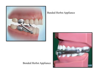 Banded Herbst Appliance
Bonded Herbst Appliance
 