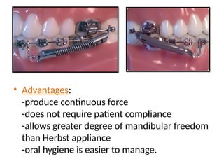 • Advantages:
-produce continuous force
-does not require patient compliance
-allows greater degree of mandibular freedom
than Herbst appliance
-oral hygiene is easier to manage.
 