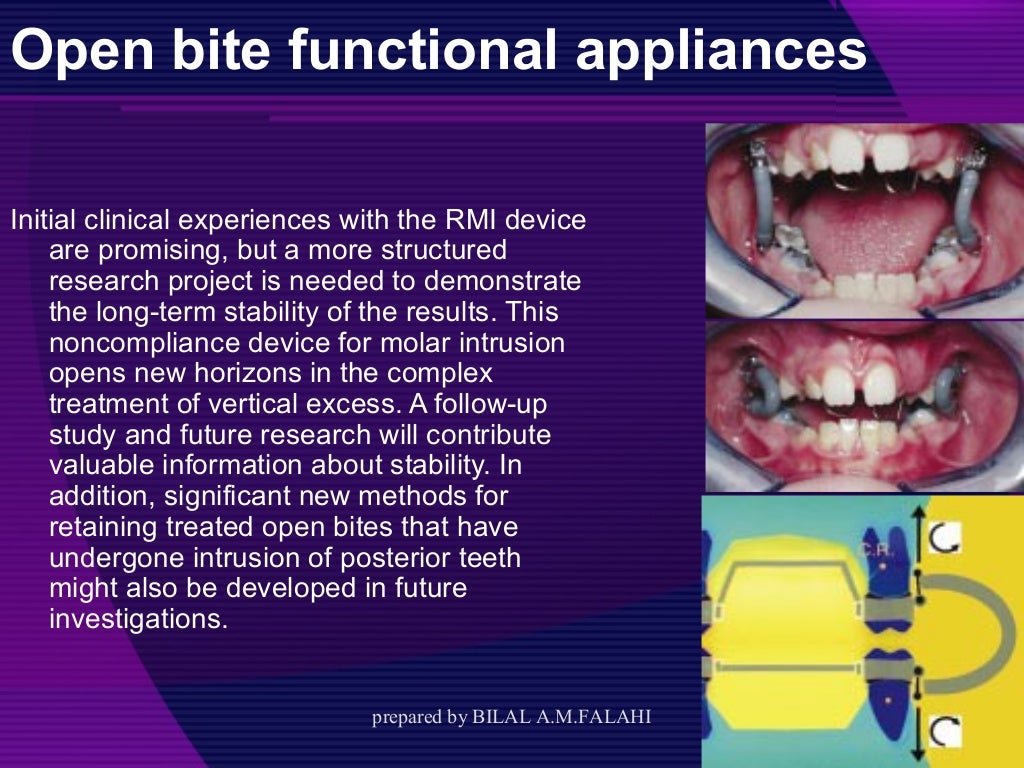 Myofunctional appliances in orthodontic