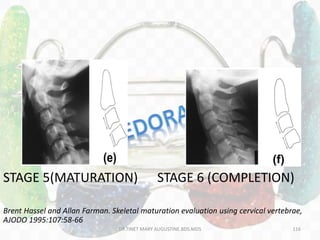 STAGE 5(MATURATION) STAGE 6 (COMPLETION)
Brent Hassel and Allan Farman. Skeletal maturation evaluation using cervical vertebrae,
AJODO 1995:107:58-66
DR.TINET MARY AUGUSTINE.BDS.MDS 116
 