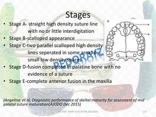 Stages
• Stage A- straight high density suture line
with no or little interdigitation
• Stage B-scalloped appearance
• Stage C-two parallel scalloped high density
lines seperated in some areas by
small low density spaces
• Stage D-fusion completed in palatine bone with no
evidence of a suture
• Stage E-complete anterior fusion in the maxilla
(Angelina et al, Diagnostic performance of skeltal maturity for assesment of mid
palatal suture maturation(AJODO Dec 2015)
DR.TINET MARY AUGUSTINE.BDS.MDS 127
 