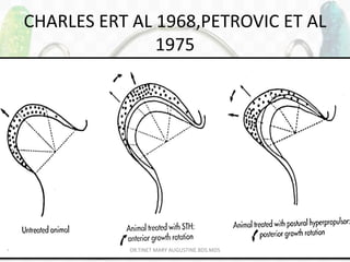 147
• Charlier et al 1968, 1969, Petrovic et al, 1975: distribution of dividing cells in the
sagittal section of condylar cartilage of juvenile rats.
• Histologic and radiographic study.
• Results : treatment with both postural hyper propulsor and growth hormone, STH,
produced increase in growth rate of condylar cartilage as compared to controls.
• Location of increase of dividing cells :
– More posterior in hyperpropulsor
– More anterior in STH
CHARLES ERT AL 1968,PETROVIC ET AL
1975
DR.TINET MARY AUGUSTINE.BDS.MDS
 