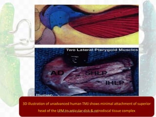 153
3D illustration of unadvanced human TMJ shows minimal attachment of superior
head of the LPM to articular disk & retrodiscal tissue complexDR.TINET MARY AUGUSTINE.BDS.MDS
 