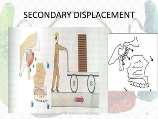 SECONDARY DISPLACEMENT
DR.TINET MARY AUGUSTINE.BDS.MDS 23
 