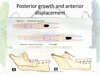 Posterior growth and anterior
displacement
DR.TINET MARY AUGUSTINE.BDS.MDS 40
 