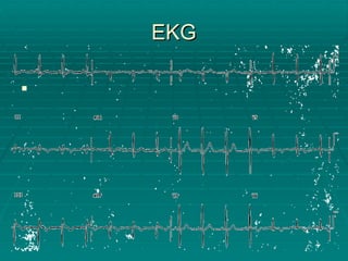EKG 