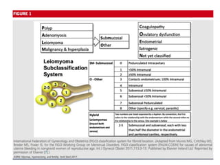 Dilemmas in Management of Fibroid | PPTX