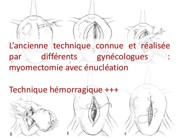 Myomectomie a moindre hemorragie m sago
