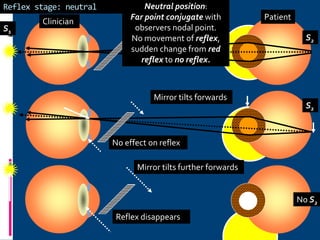 Reflex stage: neutral
Clinician
Patient
No effect on reflex
Reflex disappears
Mirror tilts forwards
Mirror tilts further forwards
S2
S2
No S2
S1
Neutral position:
Far point conjugate with
observers nodal point.
No movement of reflex,
sudden change from red
reflex to no reflex.
 