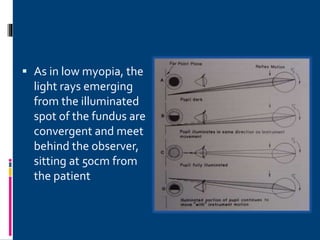  As in low myopia, the
light rays emerging
from the illuminated
spot of the fundus are
convergent and meet
behind the observer,
sitting at 50cm from
the patient
 