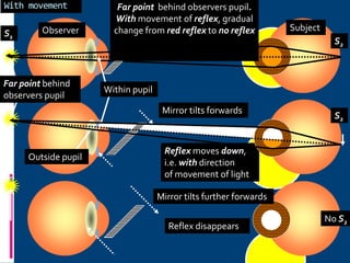 Observer Subject
Reflex disappears
Reflex moves down,
i.e. with direction
of movement of light
Mirror tilts further forwards
Mirror tilts forwards
S2
S2
Far point behind
observers pupil
Within pupil
Outside pupil
No S2
S1
With movement Far point behind observers pupil.
With movement of reflex, gradual
change from red reflex to no reflex
 