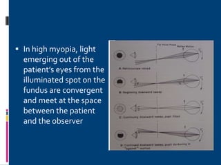  In high myopia, light
emerging out of the
patient’s eyes from the
illuminated spot on the
fundus are convergent
and meet at the space
between the patient
and the observer
 