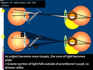 Degree of ametropia and the
reflex
As subject becomes more myopic, the cone of light becomes
wider
Greater portion of light falls outside of practitioner’s pupil, so
dimmer reflex
1
2
 