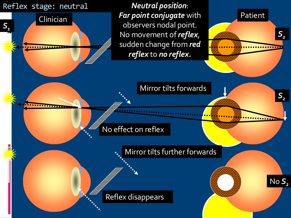 Retinoscopy