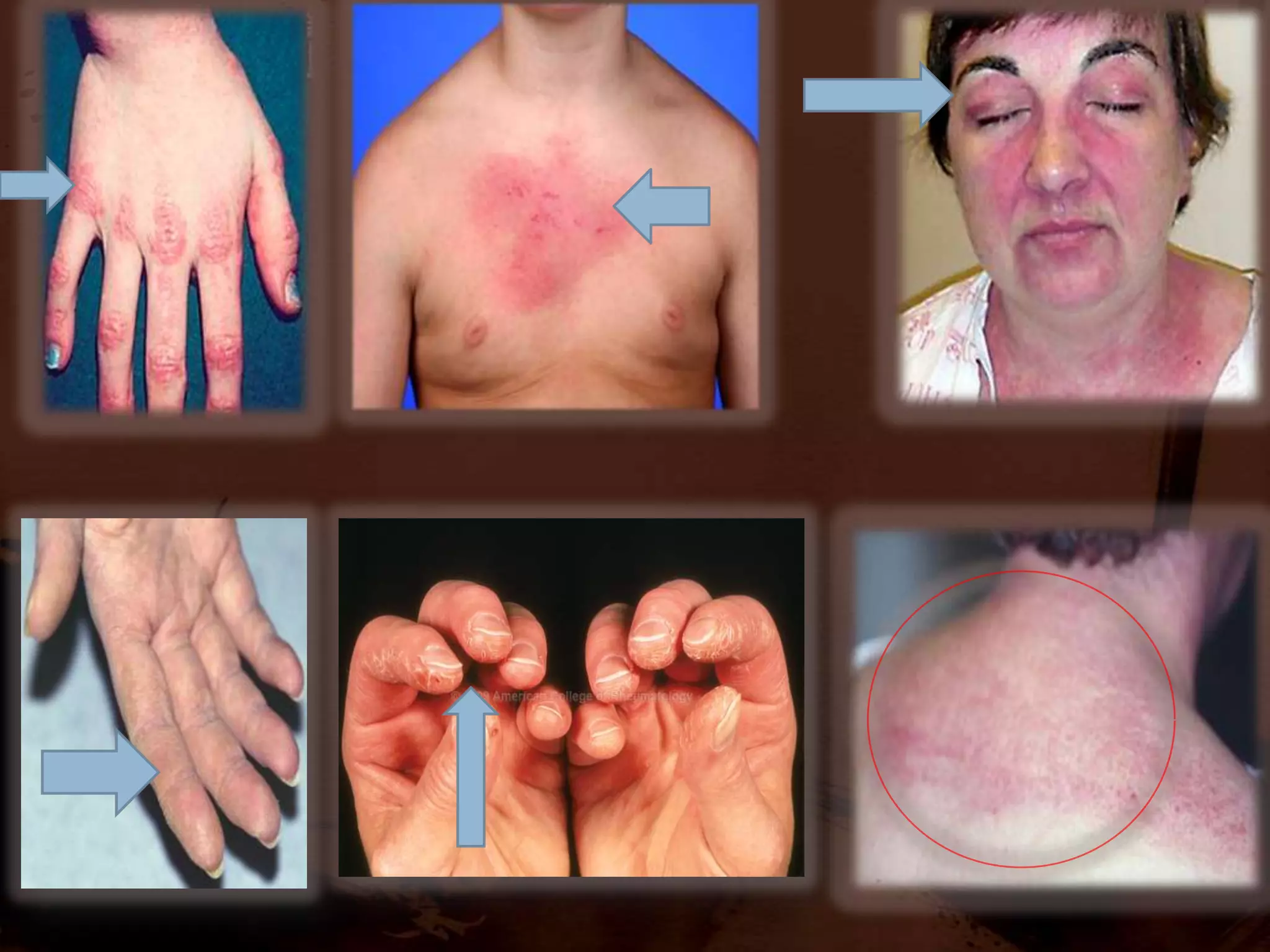 CLASSIFICATION1.INFLAMMATORY /INFECTIOUS MYOPATHIES