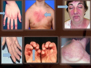 CLASSIFICATION1.INFLAMMATORY /INFECTIOUS MYOPATHIES