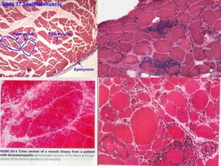 PATHOGENESISAutoimmune etiology  - assosciation with other autoimmune CTD ,various Auto Ab, MHC ,T CELL myotoxicity,complement, response to immunotherapy.