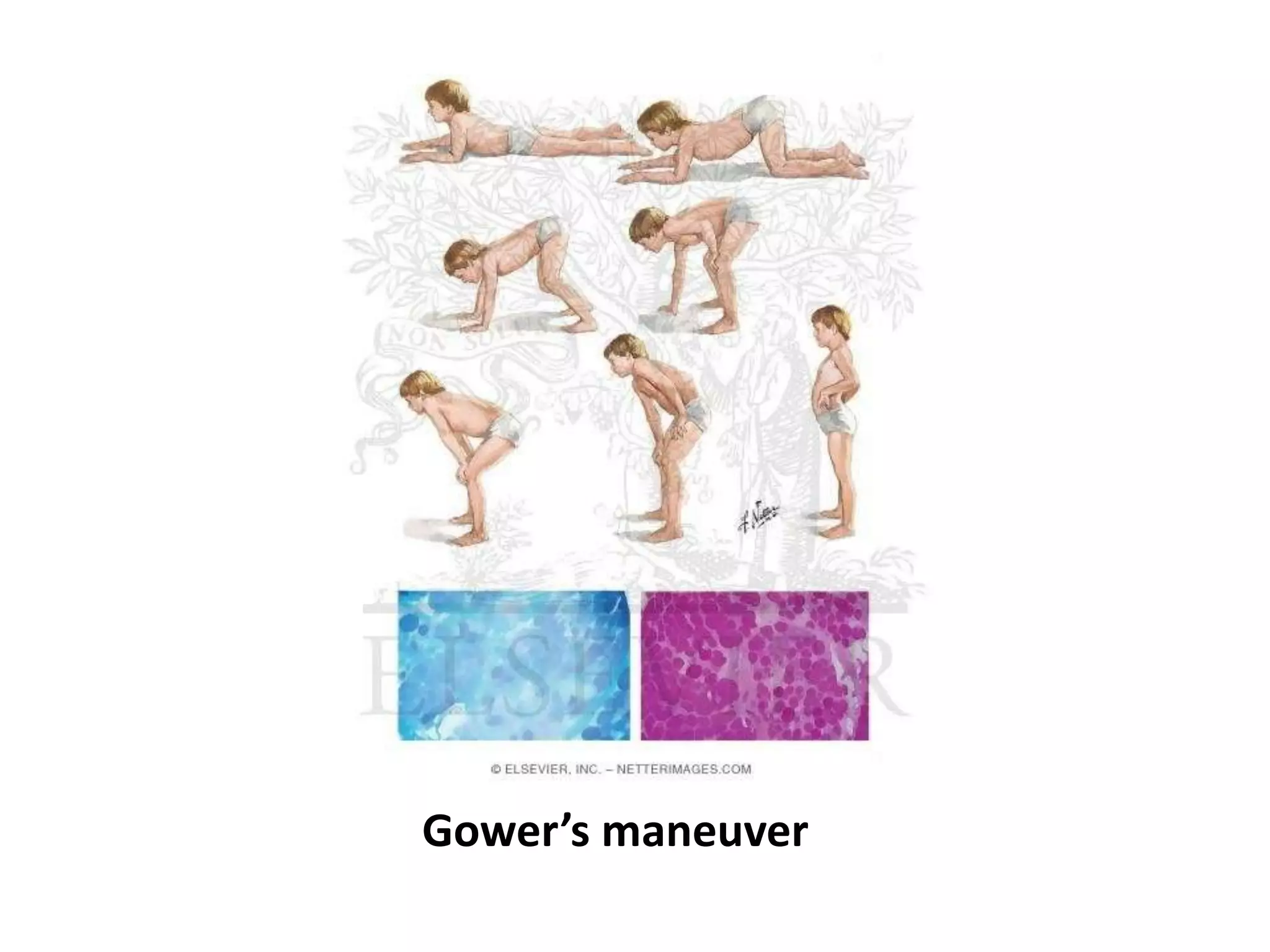 Gower’s maneuver
 