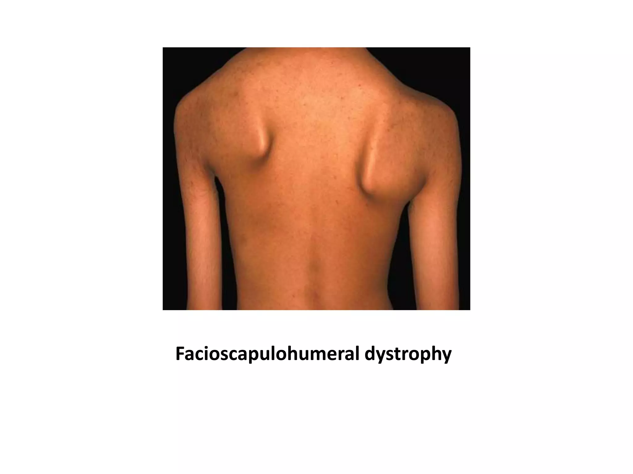 Facioscapulohumeral dystrophy
 