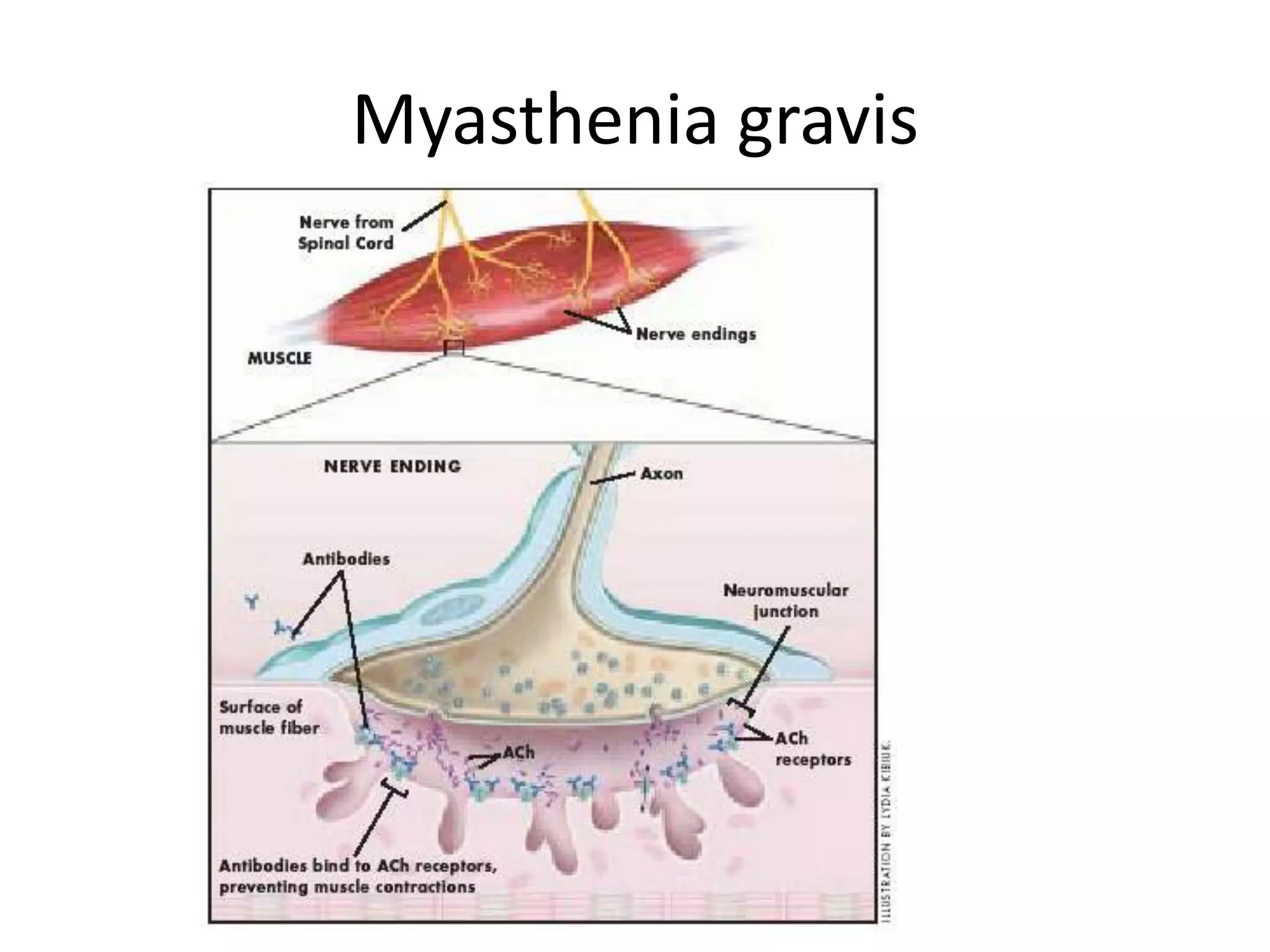 Myasthenia gravis
 