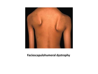 Facioscapulohumeral dystrophy
 