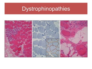 Dystrophinopathies
 