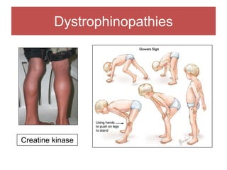 Dystrophinopathies
Creatine kinase
 