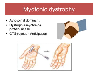 Myotonic dystrophy
• Autosomal dominant
• Dystrophia myotonica
protein kinase
• CTG repeat – Anticipation
 