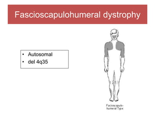 Fascioscapulohumeral dystrophy
• Autosomal
• del 4q35
 