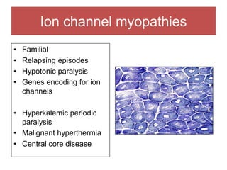 Ion channel myopathies
• Familial
• Relapsing episodes
• Hypotonic paralysis
• Genes encoding for ion
channels
• Hyperkalemic periodic
paralysis
• Malignant hyperthermia
• Central core disease
 