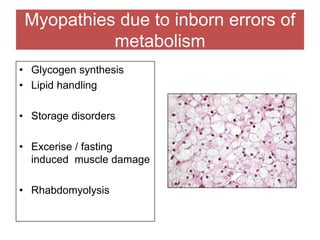 Myopathies due to inborn errors of
metabolism
• Glycogen synthesis
• Lipid handling
• Storage disorders
• Excerise / fasting
induced muscle damage
• Rhabdomyolysis
 