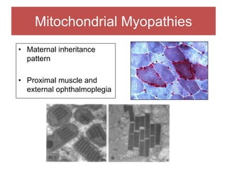 Mitochondrial Myopathies
• Maternal inheritance
pattern
• Proximal muscle and
external ophthalmoplegia
 