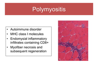 Polymyositis
• Autoimmune disorder
• MHC class I molecules
• Endomysial inflammatory
infiltrates containing CD8+
• Myofiber necrosis and
subsequent regeneration
 
