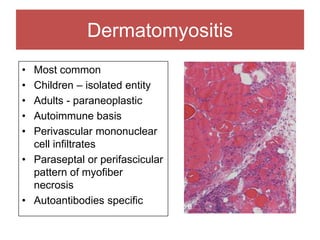 Dermatomyositis
• Most common
• Children – isolated entity
• Adults - paraneoplastic
• Autoimmune basis
• Perivascular mononuclear
cell infiltrates
• Paraseptal or perifascicular
pattern of myofiber
necrosis
• Autoantibodies specific
 