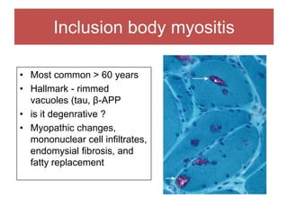 Inclusion body myositis
• Most common > 60 years
• Hallmark - rimmed
vacuoles (tau, β-APP
• is it degenrative ?
• Myopathic changes,
mononuclear cell infiltrates,
endomysial fibrosis, and
fatty replacement
 
