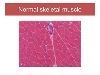 Normal skeletal muscle
 