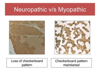 Neuropathic v/s Myopathic
Loss of checkerboard
pattern
Checkerboard pattern
maintianed
 