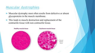 Muscular dystrophies
 Muscular dystrophy most often results from defective or absent
glycoproteins in the muscle membrane.
 This leads to muscle destruction and replacement of the
contractile tissue with non contractile tissue.
 