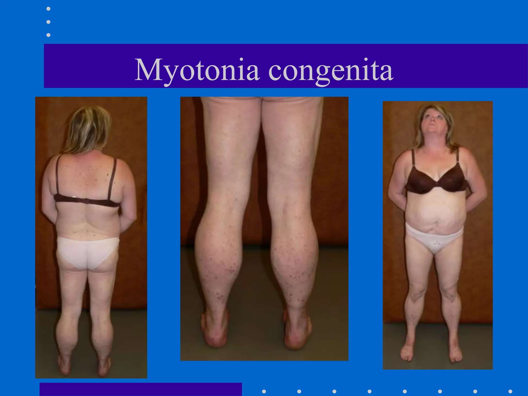 Myotonia congenita
 