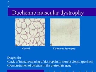 Duchenne muscular dystrophy
Diagnosis:
•Lack of immunostaining of dystrophin in muscle biopsy specimen
•Demonstration of deletion in the dystrophin gene
Normal Duchenne dystrophy
 