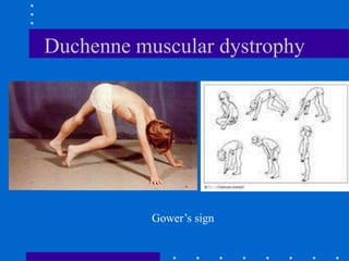 Duchenne muscular dystrophy
Gower’s sign
 