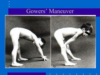 Gowers’ Maneuver
 