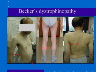 Becker´s dystrophinopathy
 