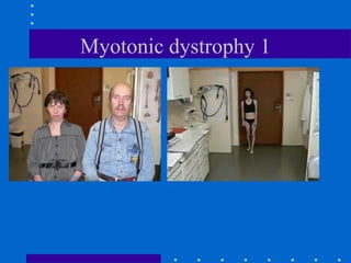 Myotonic dystrophy 1
 