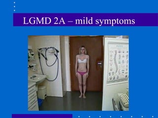 LGMD 2A – mild symptoms
 