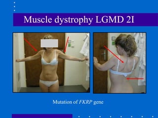 Muscle dystrophy LGMD 2I
Mutation of FKRP gene
 