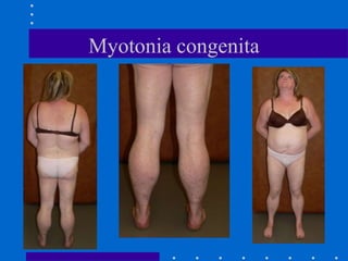 Myotonia congenita
 